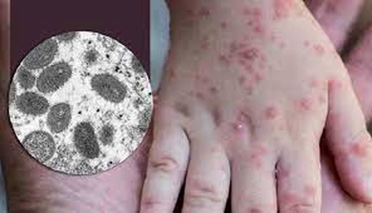 آبله میمونی رسما به ایران رسید؛ شناسایی اولین مورد ابتلای قطعی در کشور