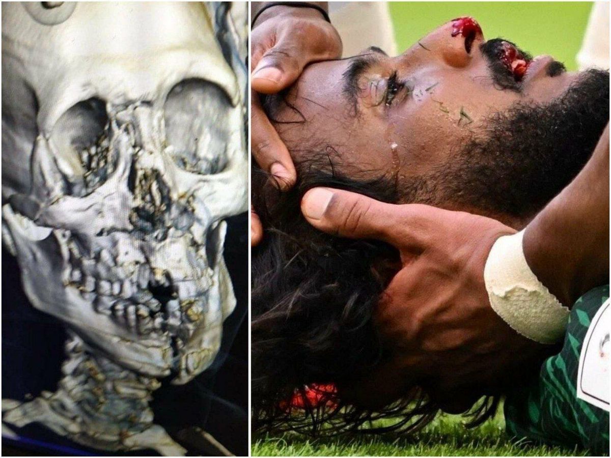 عکس؛ تصویری از جمجمه شکسته شده یاسر الشهرانی