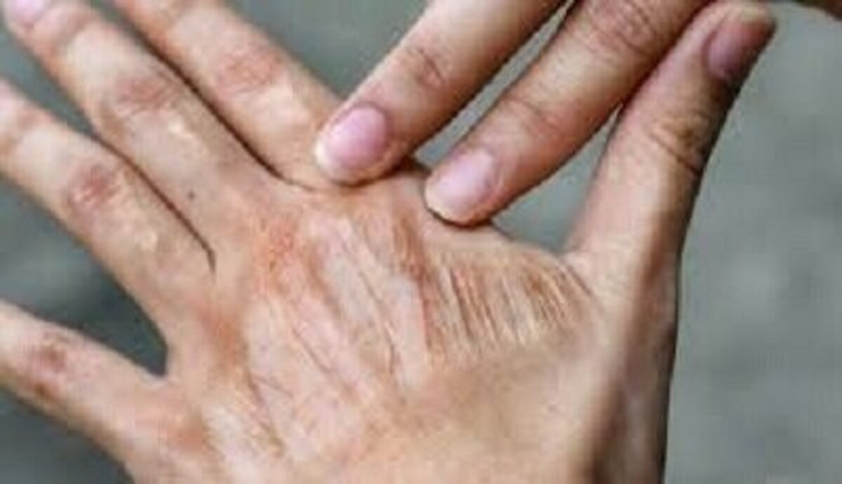 چگونه از خشکی پوست در فصل پاییز جلوگیری کنیم؟