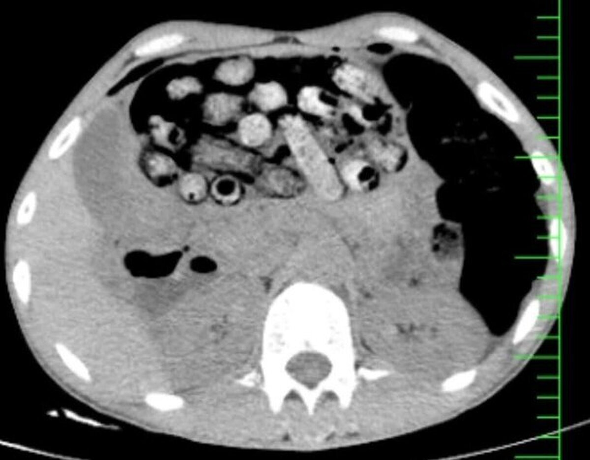 خروج ۹۰ بسته مواد مخدر از معده و روده یک بیمار در کرج +عکس