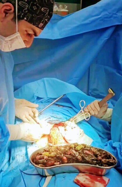 خروج ۹۰ بسته مواد مخدر از معده و روده یک بیمار در کرج +عکس