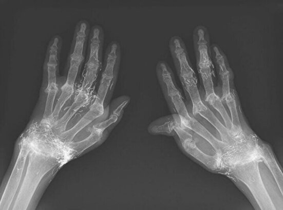 کشف صدها رشته طلای خالص در زانوی زن   ۶۵‌ساله مبتلا به آرتروز