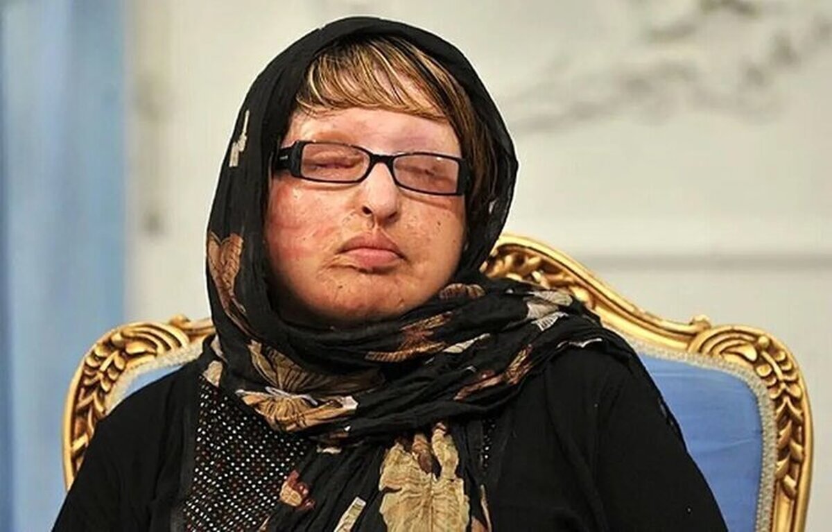 حضور آمنه بهرامی، قربانی اسیدپاشی در دادسرای جنایی تهران بعد از ۲۱سال