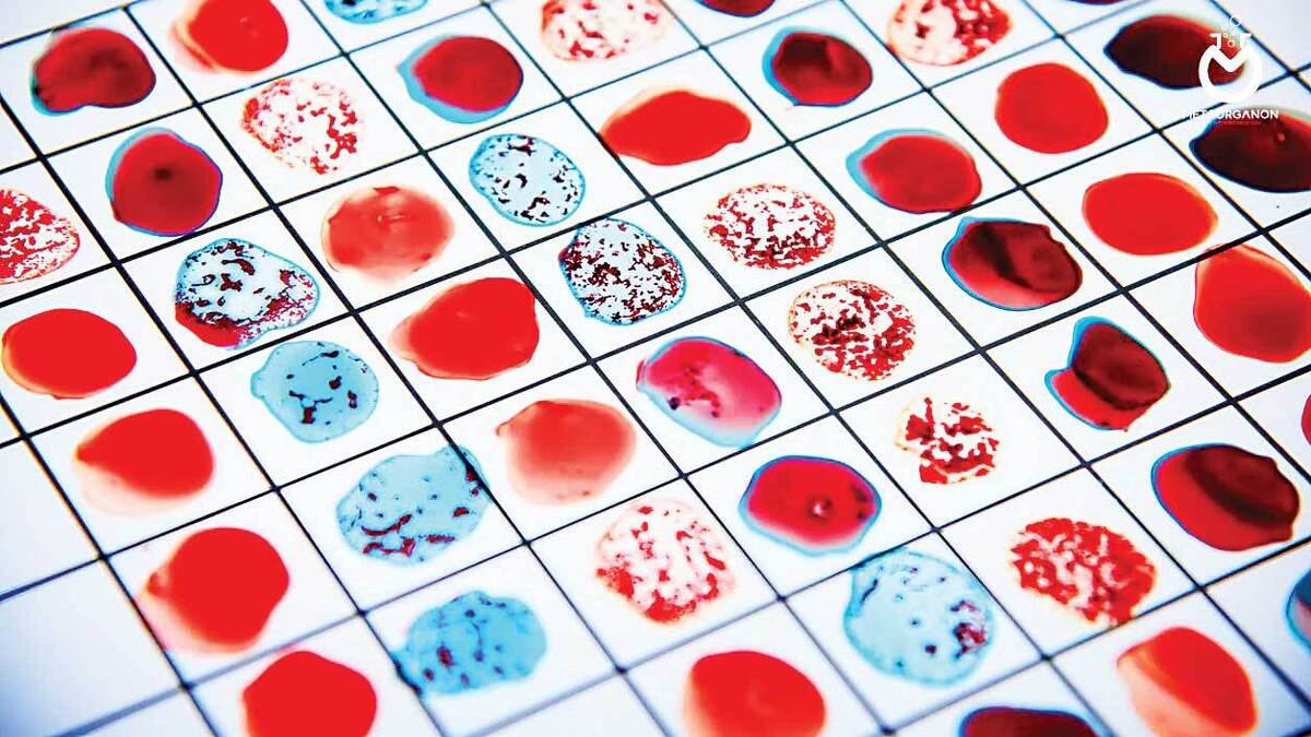 سکته مغزی در کدام گروه خونی رواج بیشتری دارد؟